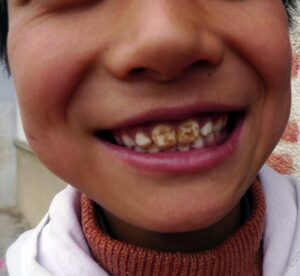 DentalFluorosis